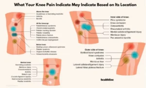 Knee Pain Location Chart